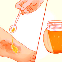 تاثیر عسل طبیعی بر زخم و سوختگی